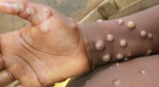 Lee más sobre el artículo Viruela del mono (monkeypox): ¿Qué es, ¿cuáles son sus síntomas, ¿Cómo se transmite y existe una vacuna?