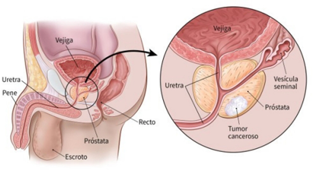 En este momento estás viendo Los grandes avances del cáncer de próstata: «Se reduce el riesgo de muerte hasta un 38 %»