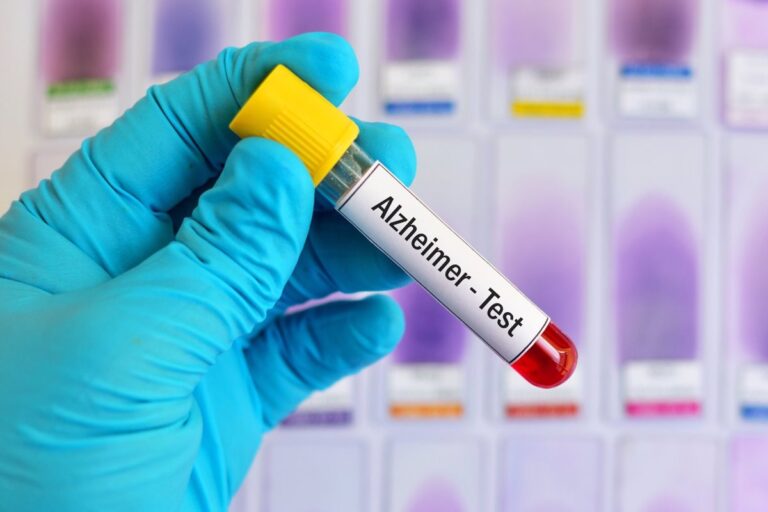 Nuevo test detecta el alzheimer con un análisis de sangre
