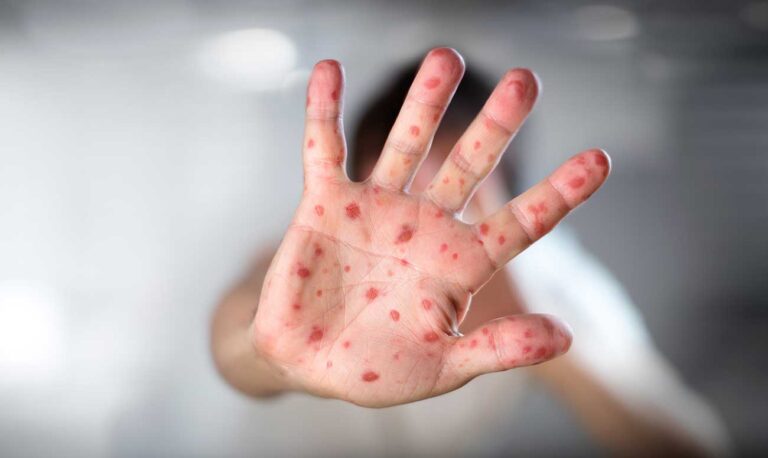 Lee más sobre el artículo OMS: más de la mitad de los países sufrirán alto riesgo de brotes de sarampión este año
