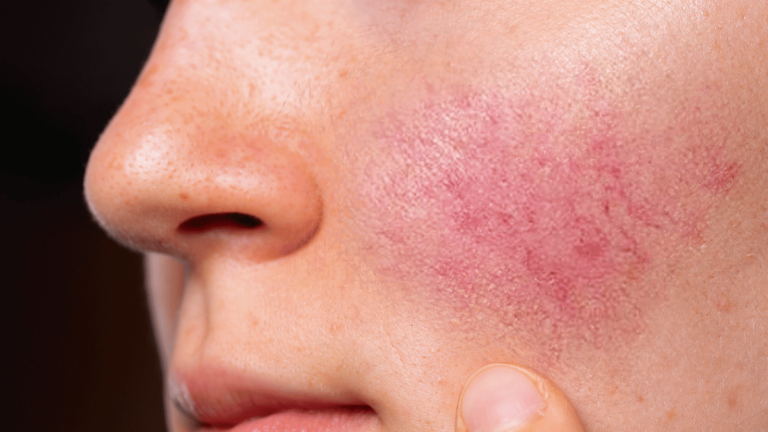 Lee más sobre el artículo Qué es la rosácea, la enfermedad de la piel que puede confundirse con acné