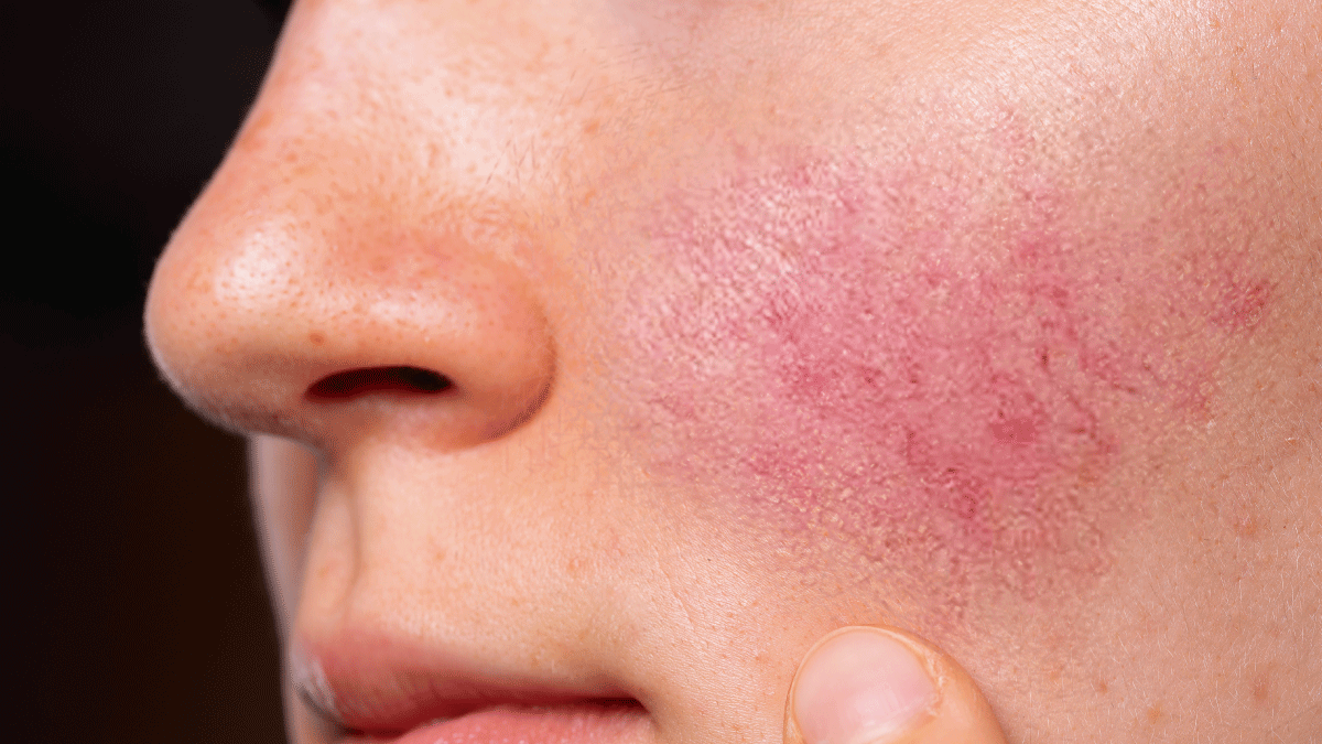 En este momento estás viendo Qué es la rosácea, la enfermedad de la piel que puede confundirse con acné